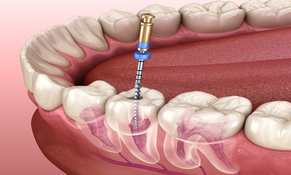 Signs That You May Need a Second Root Canal Procedure