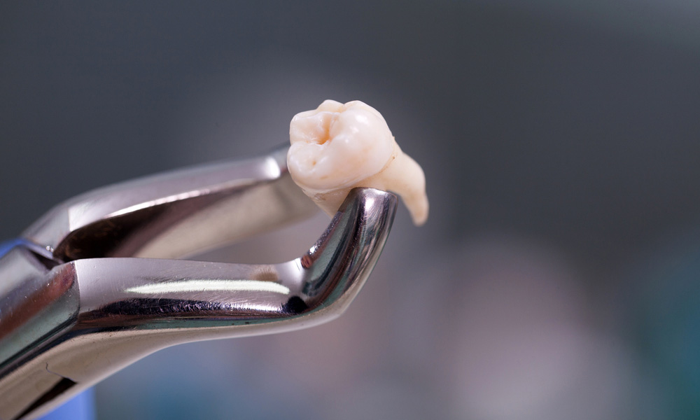 Why Some Tooth Extractions Heal Faster Than Others