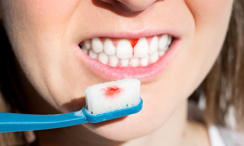 Why Tiny Black Spots on Teeth Should Not Be Ignored