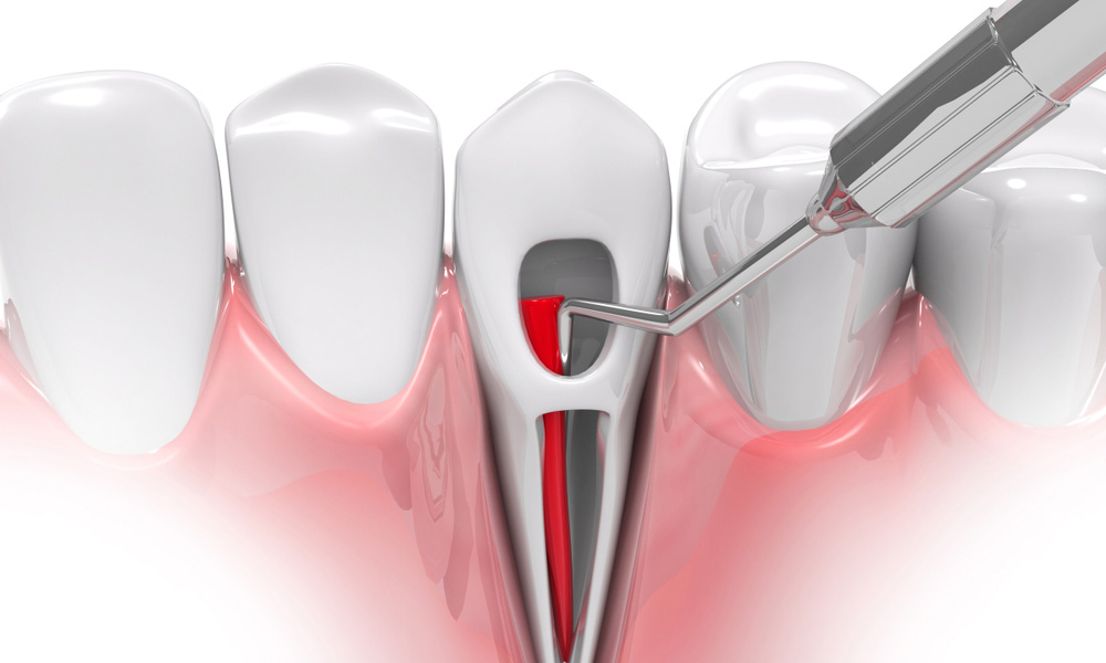 How Root Canal Treatment Saves a Tooth From Extraction